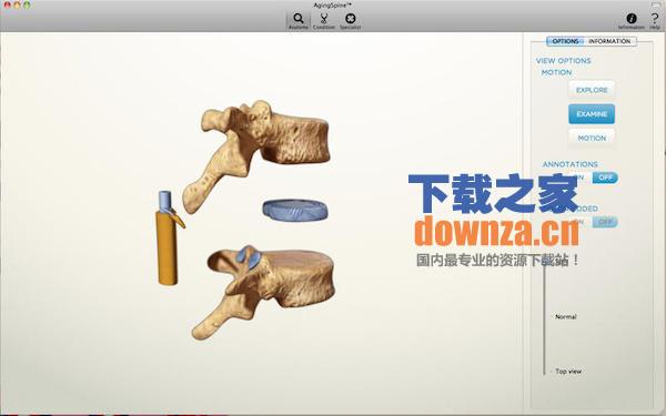 Aging Spine脊柱老化截图